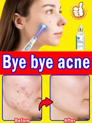 Per crema anti cicatrici da acne blu-ray