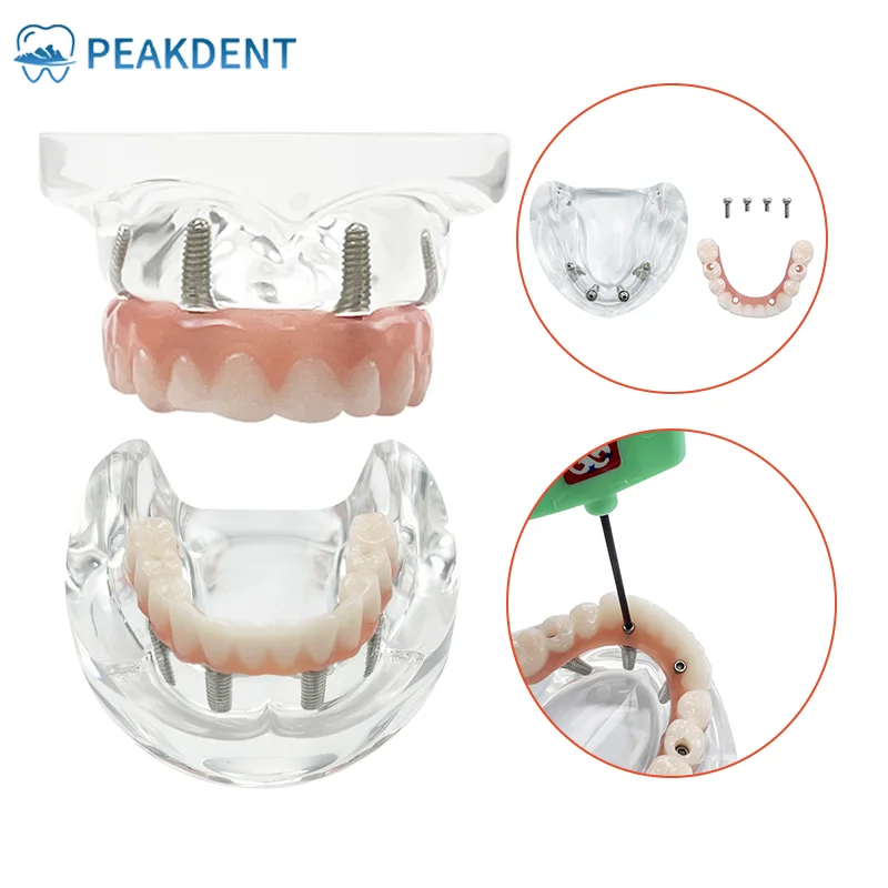 Dental Typodont Implant Study Teaching  Model With Implant Overdenture 4 Removable Screws Upper and Lower Teeth Demo Model