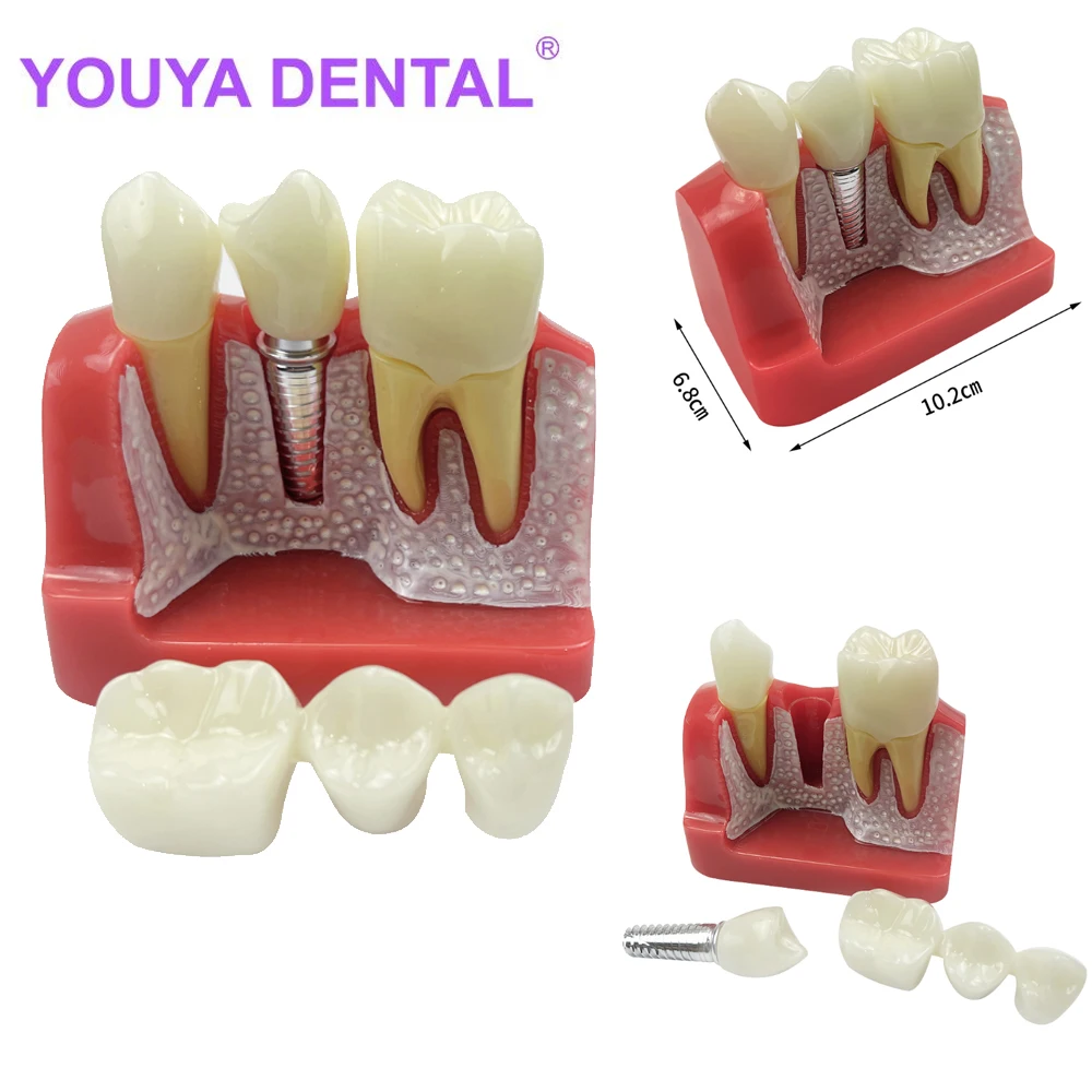 Dental Implant Teeth Model 4 Times Dentistry Teaching Study Analysis Crown Bridge Removable Dentist Patient Demonstration Model