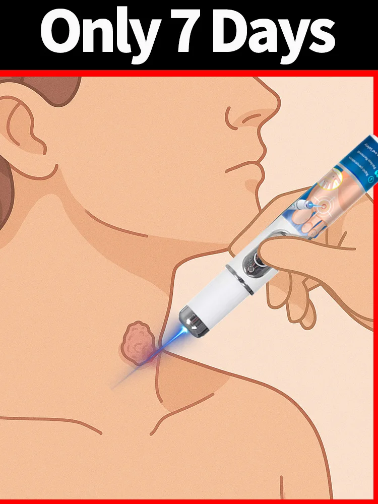 

Generation-2 Upgraded Wart Laser Pen, Solve Warts Root Quickly
