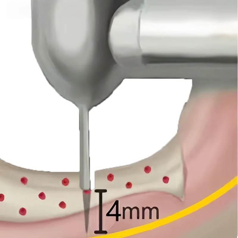 JAVIDENT Dental Implant Long Lance Pilot Drills Implant Burs  Nutrient Hole Drill Bits  Instruments and Materials