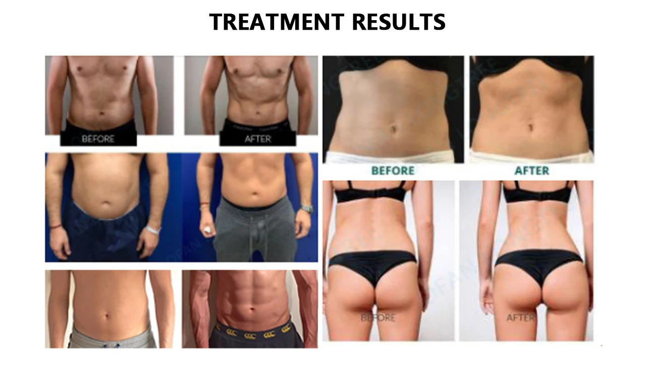 النحات المحمول زيادة كتلة العضلات وتقليل الدهون اثنين من مقبض العمل تبريد الهواء 300us نبض 12 بوصة حجم الشاشة #6