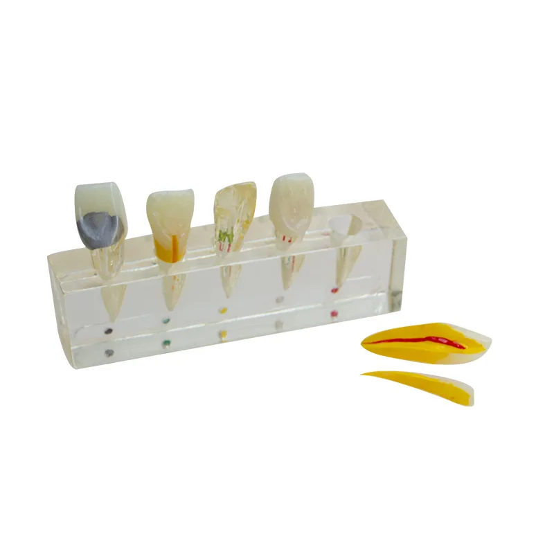 2Pcs Dental endodontic pathological anterior front labial teeth model dental lab dentistry endo model