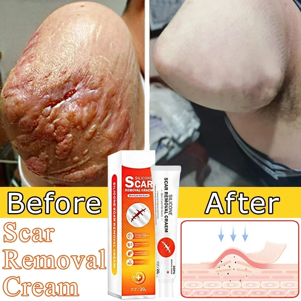 

Scar Removal Cream Remove Acne Spots Treatment Stretch Marks Burn Surgical Scar Smoothing Whitening Pigmentation Care