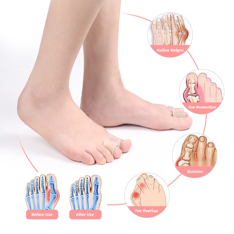 Silicone Gel Thumb Toe Separadores, Bunion Espalhador, Corretor Pads, Alisador, Orthotic Foot Care Tools, Hallux Valgus, 2Pairs