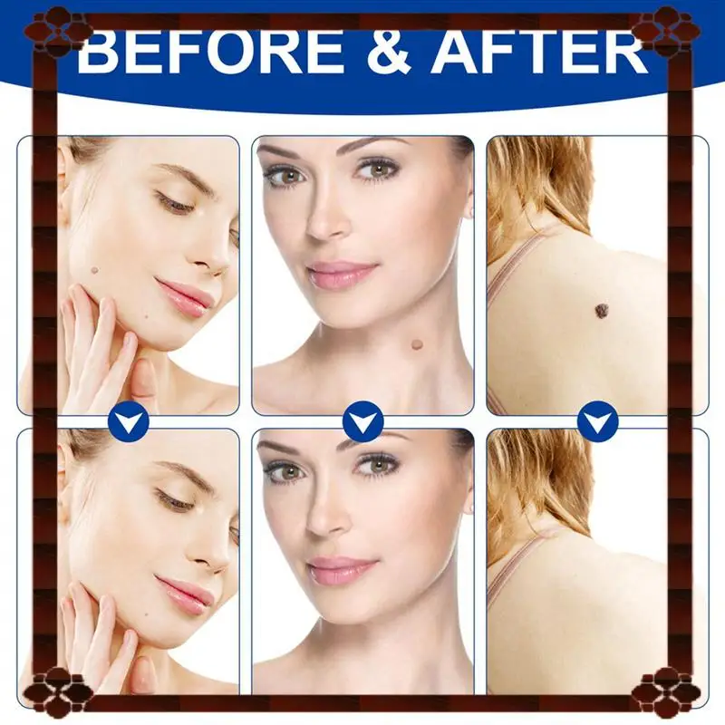 

24-Hour Delivery 2X Skin Tag Removal Kit Painless Skin Tag Removal Pen Easy Skin Tag Removal Device Removes 4Mm-9Mm Skin Tags