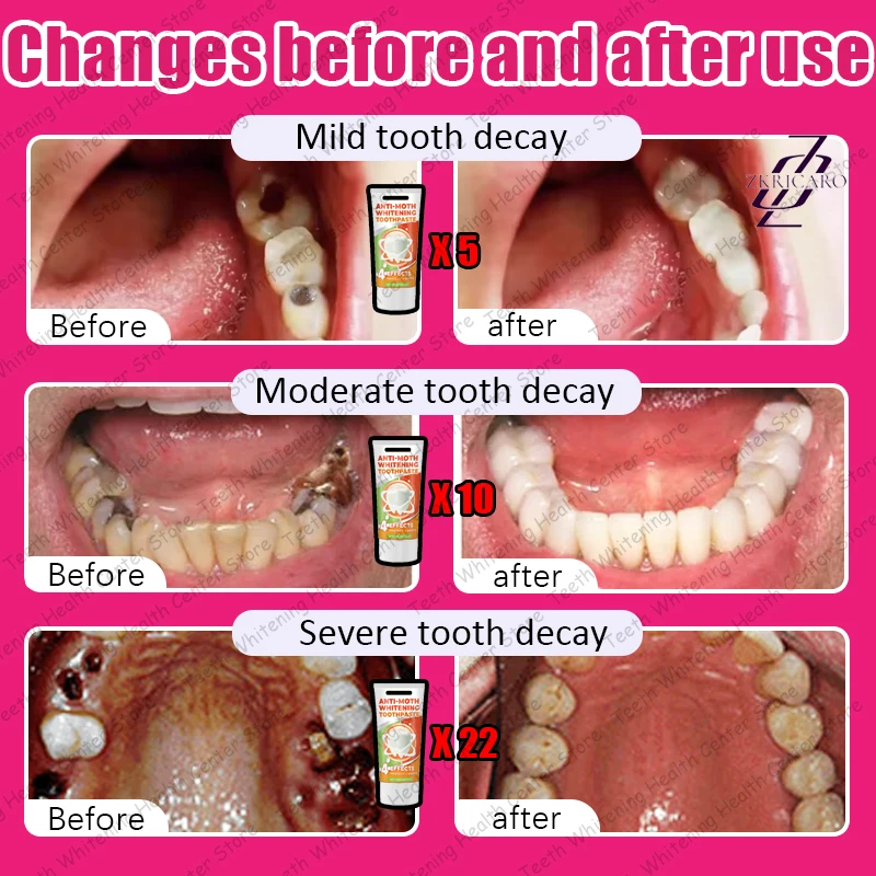 99% of people repurchase, hot selling, repair tooth decay