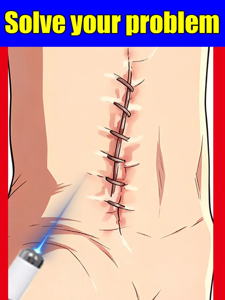 

Popular Choice Hot sale Blue light laser Diminish Scar solve your problem