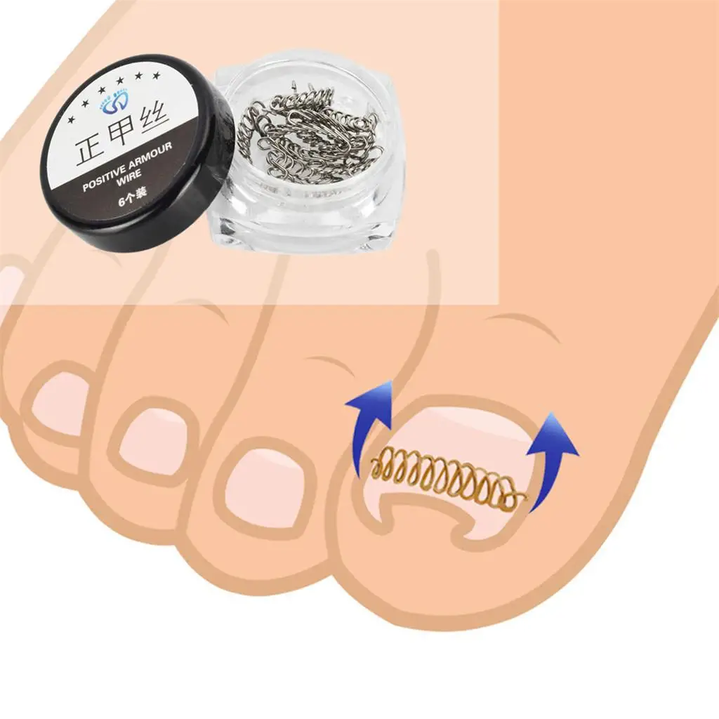 Ingrown Toe Nail Correction Wire Prevents The Toenail Ingrowing , Pain,