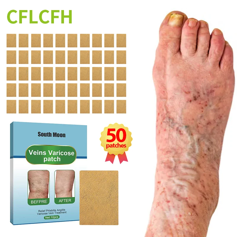 

50Pcs Varicose Veins Relief Patch Vasculitis Phlebitis Spider Leg Varicosity Angiitis Legs Dilated Treatment Foot Care Plaster