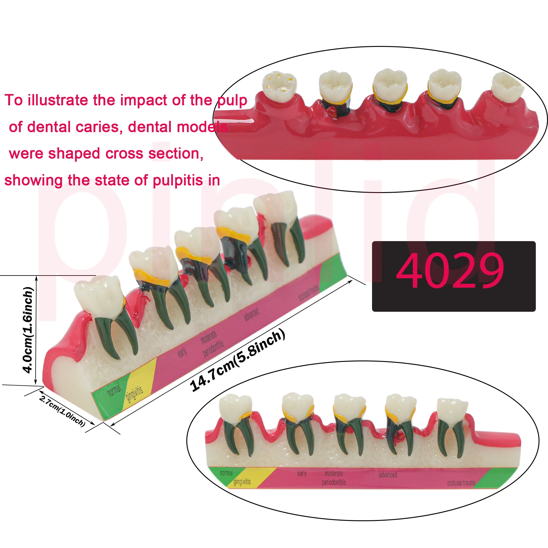 Dental Periodontal Disease Model  Typodont Teeth Disease Demo Teaching Model Caries M4029 1/5pcs