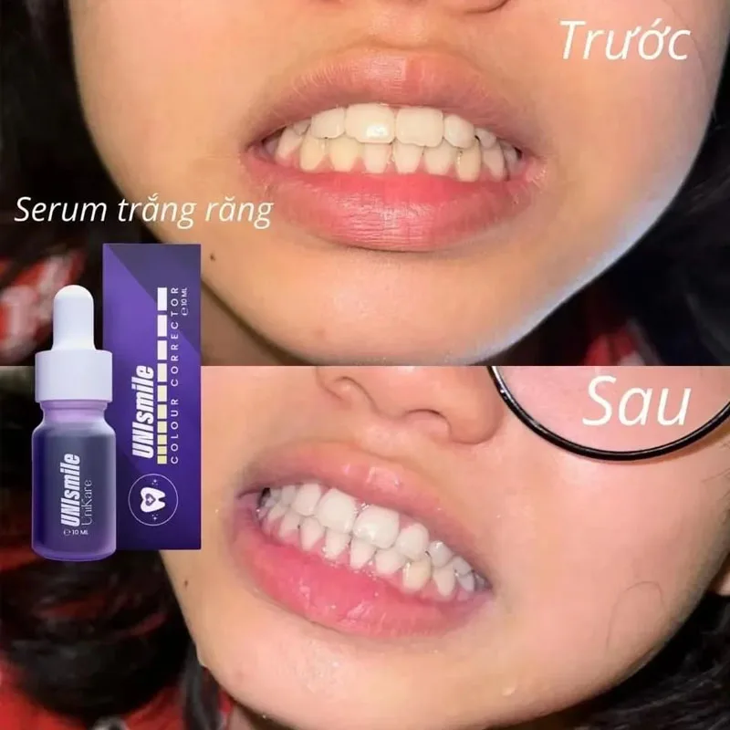 Serum Trắng Răng Unismile, Hỗ Trợ Cải Thiện Vết Ố Vàng Răng, Làm Sạch Mảng Bám Trên Răng, Unikare, Dung Tích 10ml