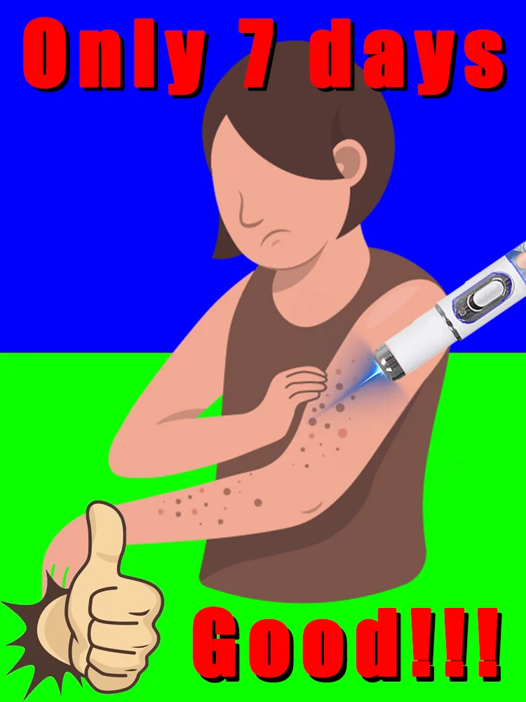 

blue light pen solve warts,painless,beauty,quickly,hotsale wart care tools,free shipping