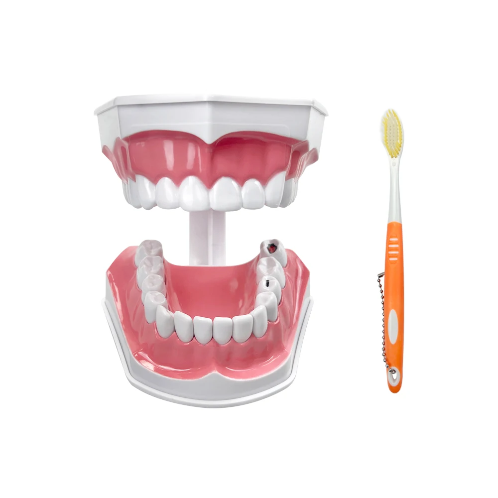 Dental Demonstration Model With Caries Standard Brushing Teeth Education Teaching Study Model With Toothbrush Dentistry Tools