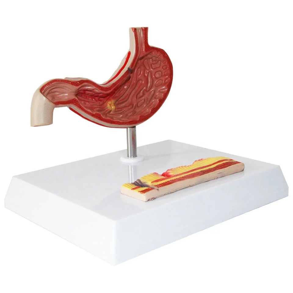 Medical Science Human Pathology Stomach Anatomy Model Human Anatomical Organ Disease Model