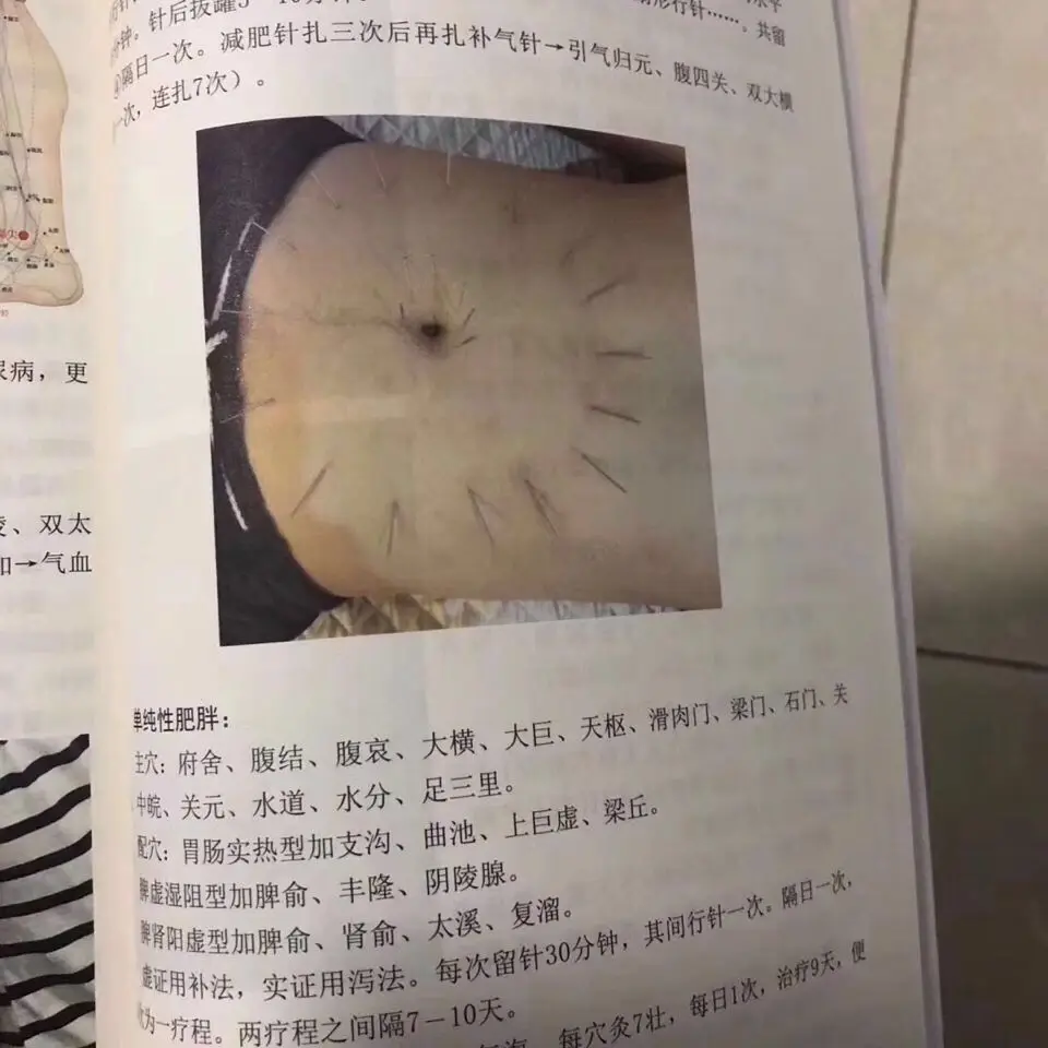 Abdominal Acupuncture Therapy Traditional Chinese Medicine Treatment Stunning Essential Printing Chinese Edition