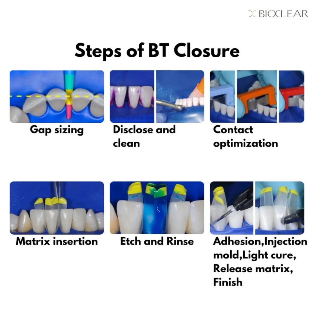 Dental Transparent Clear Matrix Anterior Posterior Restoration BT Bow Matrices Contoured Fit BioClear 1.901/1.907/1.908/1.909