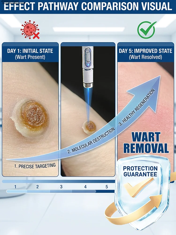 

ᵂᵃʳᵗ ʳᵉᵐᵒᵛᵃˡ ᵃᵗ ʰᵒᵐᵉ ⁱˢ ˢᵘᵖᵉʳ ᶜᵒⁿᵛᵉⁿⁱᵉⁿᵗ! Warts will gradually fall off 2026