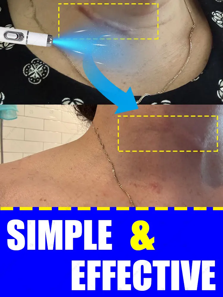 

Новейшая технология удаления шрамов, удаление шрамов за 7-днем.