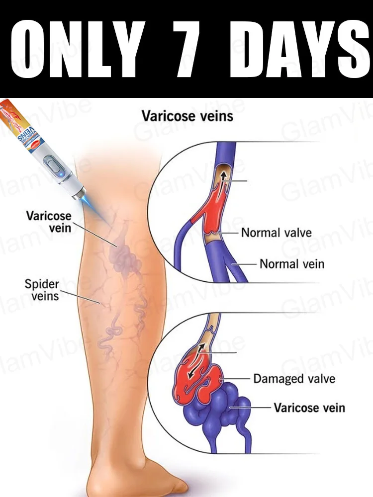 

blue light pen solve varicose veins, hot sale leg care tools