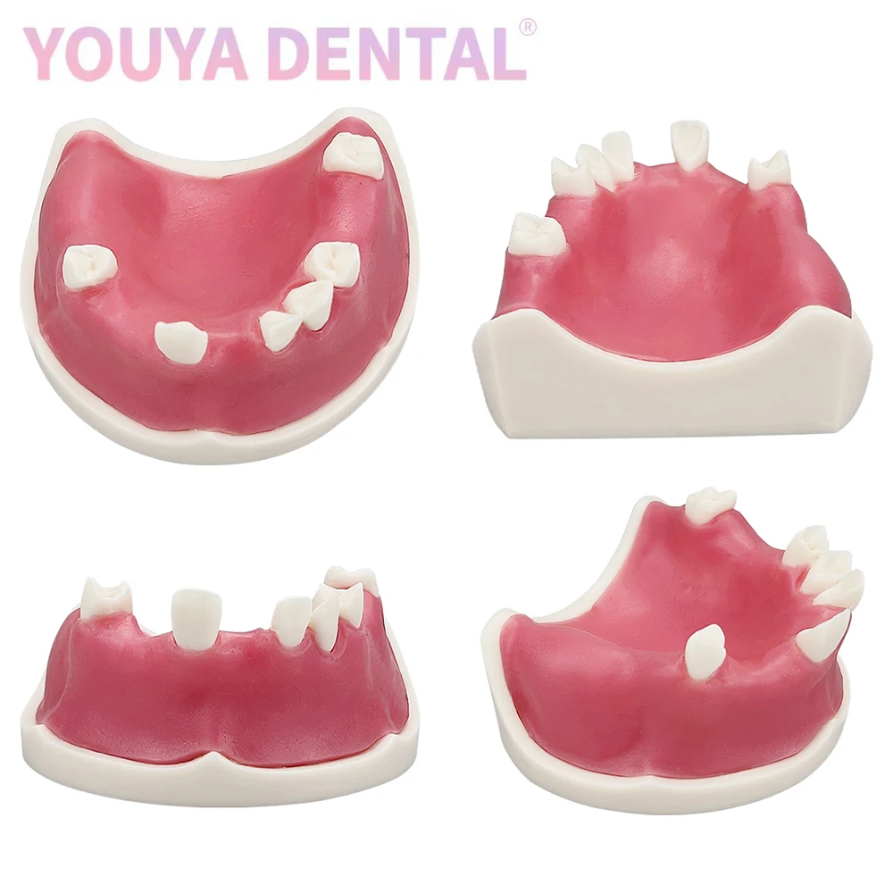 Typodont-modelo de implante Dental maxilar, dientes faltantes con práctica de encías blandas, modelo de entrenamiento para estudiantes, herramienta de práctica