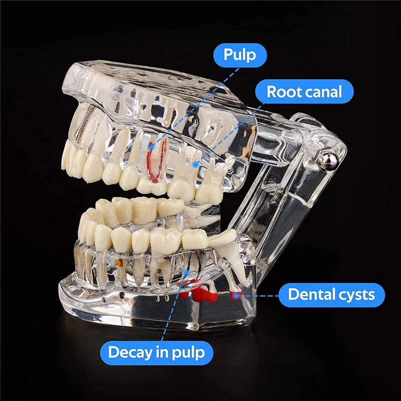 

1 PCS Transparent Disease Teeth Model With Implant Bridge, Transparent Plastic For Patient And Student Education