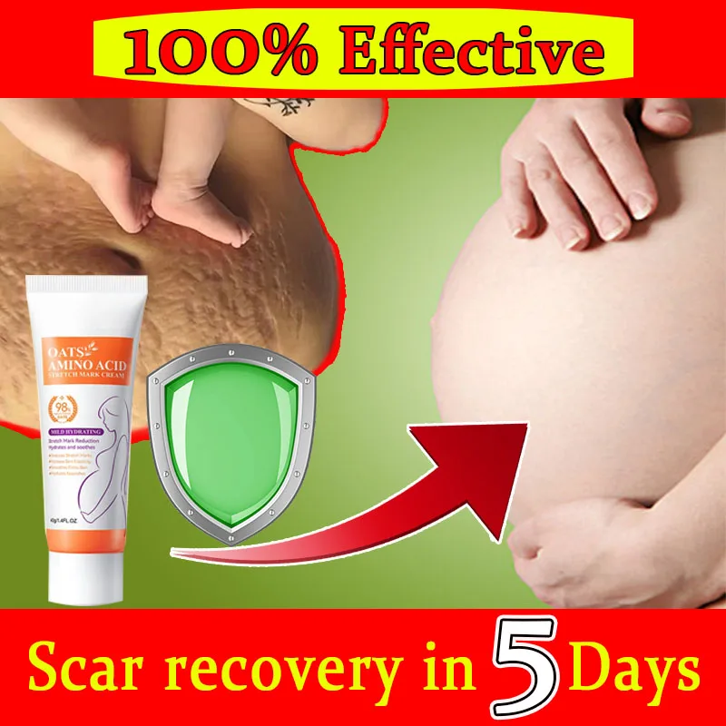 Crème anti-cicatrices pour les brûlures, gel avancé, acène, section C, marques commandées, crème d'élimination des chéloïdes