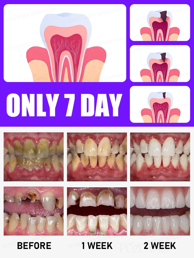 2025年防水パッチ、インレイ歯の矯正パッチ、変色や損傷用