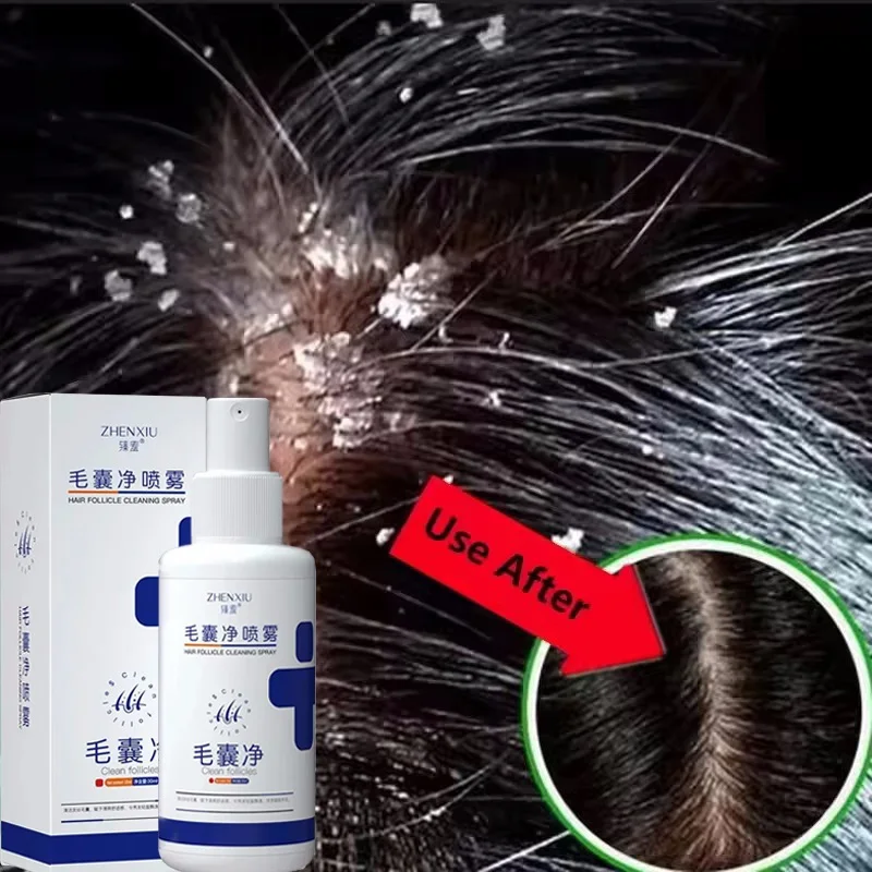 

Hair Scalp Treatment Essence Spray Dandruff Itching Oil Control Anti Loss Scalp Cleaning Repair Serum Beauty Hair Care Products