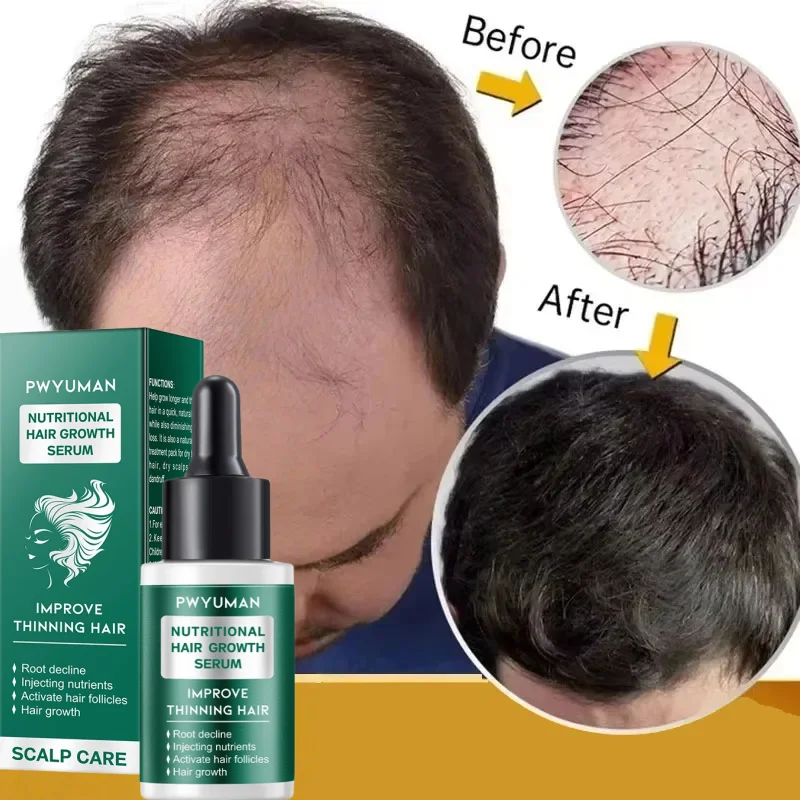 

Масло для быстрого роста волос Africa Crazy Traction Alopecia Сыворотка против разрыва волос, утепленный спрей для лечения выпадения волос для мужчин и женщин