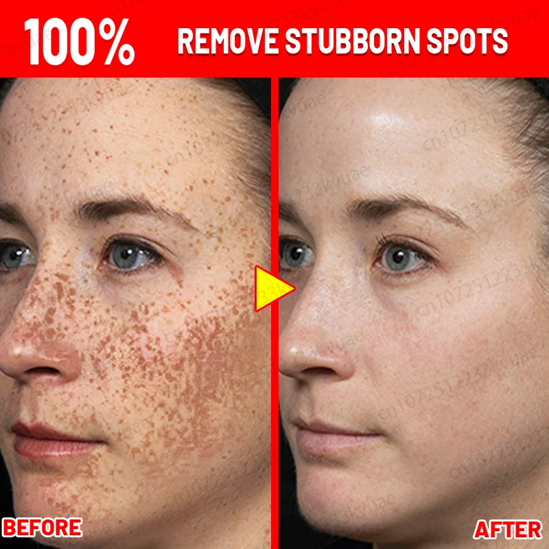 

Freckles Removal Essence Remove Facial Spots Skin Dark Spot Remove Melasma Spots Sunspots Whitening And Freckle Removing Cream