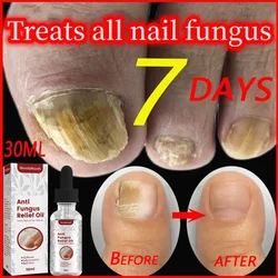 Fast Onychomycosis Fungus Nail Repair