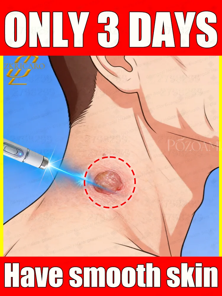 

The longer these stubborn bumps are left untreated⸴ ᵗʰᵉ ʰᵃʳᵈᵉʳ ᵗʰᵉʸ ᵇᵉᶜᵒᵐᵉ ᵗᵒ ʳᵉᵐᵒᵛᵉ‧