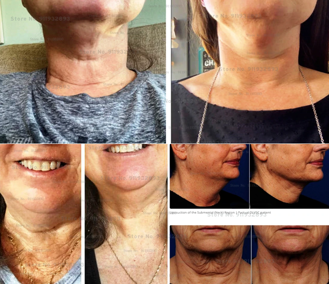 

Neck Chest Cream Neck Lift Anti Wrinkle ANTI-AGING DARK NECK WHITENING BRIGHTENING WRINKLE Hyaluronic Acid Skin Care Products