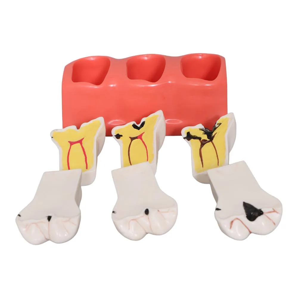 Dental Caries Disintegration Model Caries Development Model 3 Stage Quadruple Multiplication Dental Model