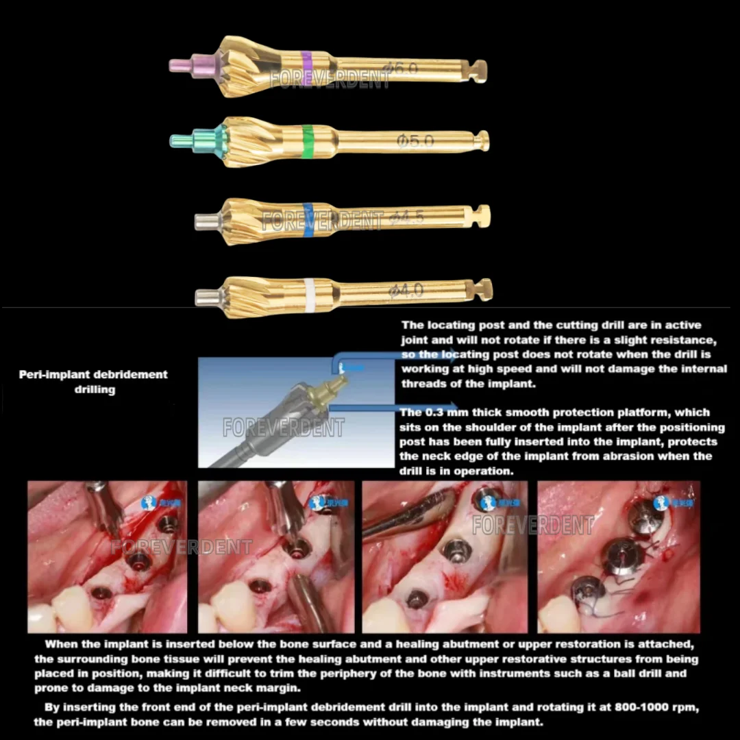 

Dental Grinding Bur Universal Implant Bone Profiler With Pilot Drill Implant Debridement Surgical Instrument