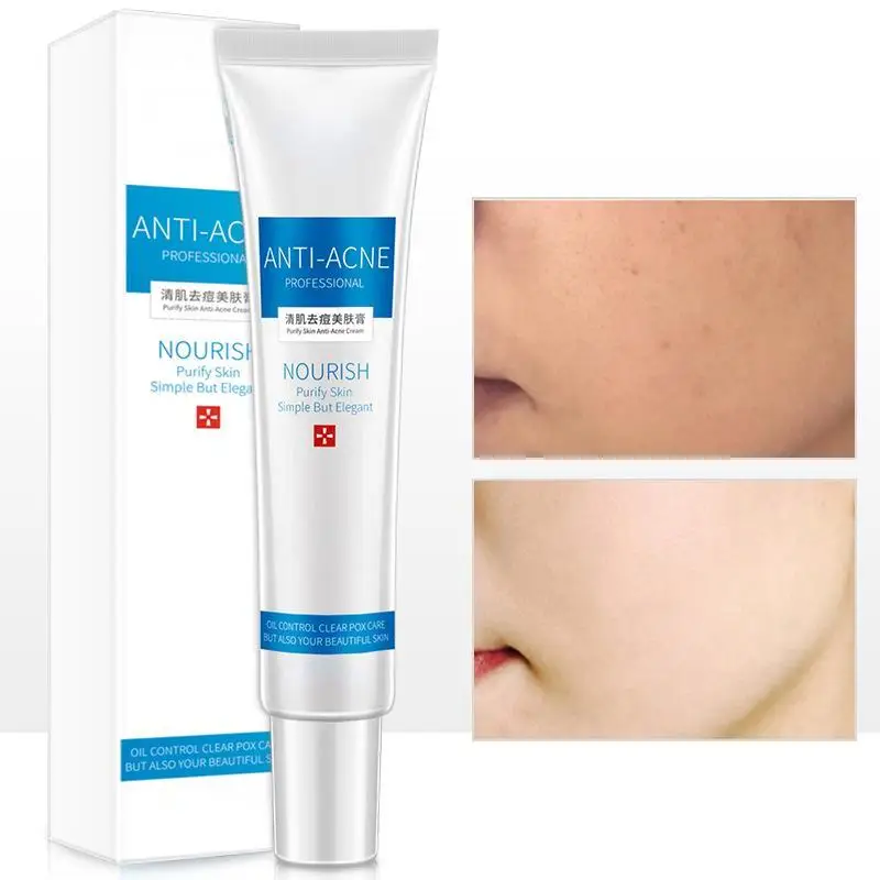 

Acne Treatment Cream Moisturizing Control Oil Shrinking Pores Remove Marks Pimple Removal Product