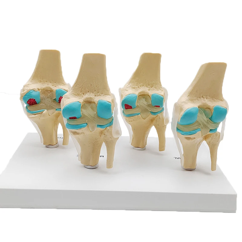 Four-stage Human Pathological Knee Joint Anatomy Model Medical Science Teaching Resources Dropshipping