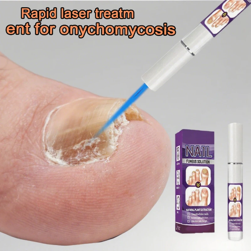 

Профессиональная лазерная ручка с грибком для ногтей