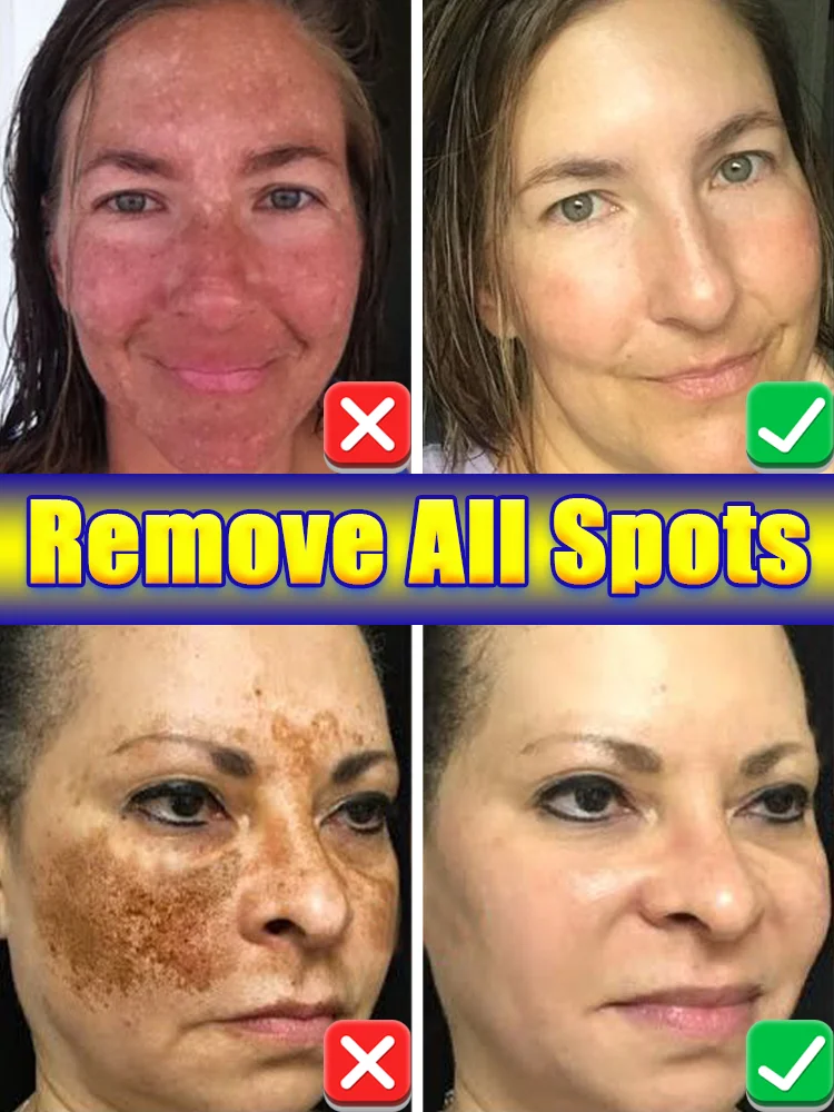 

7-day highly effective freckle cream, perfect solution to freckles caused by various reasons