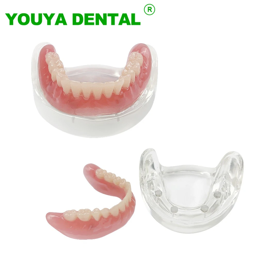 

Dental Teeth Model With Removable Bridge 4 Implants Upper Overdenture Superior Demo Model Student Dentist Patient Communication