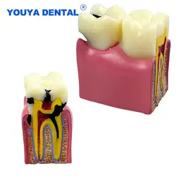 Dental Caries Comparsion Tooth Models 6 Times Study Models For Dentist Studying Teaching Anatomy Practice Dentistry Teeth Model