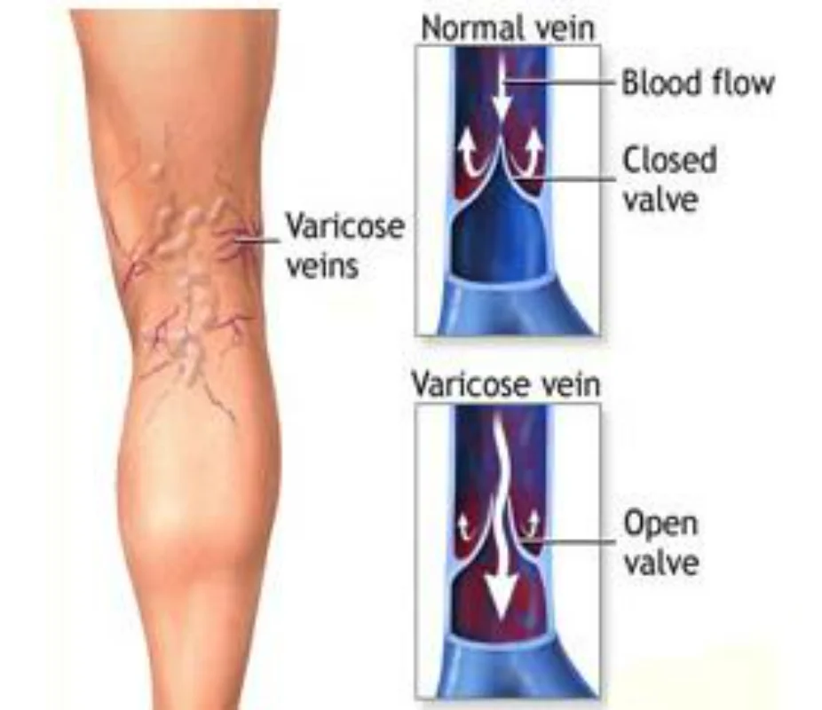 1 paio di calzini a compressione prevenire le vene Varicose della coscia indolenzimento delle donne calzino dimagrante uomo sport all'aria aperta calza a pressione del polpaccio