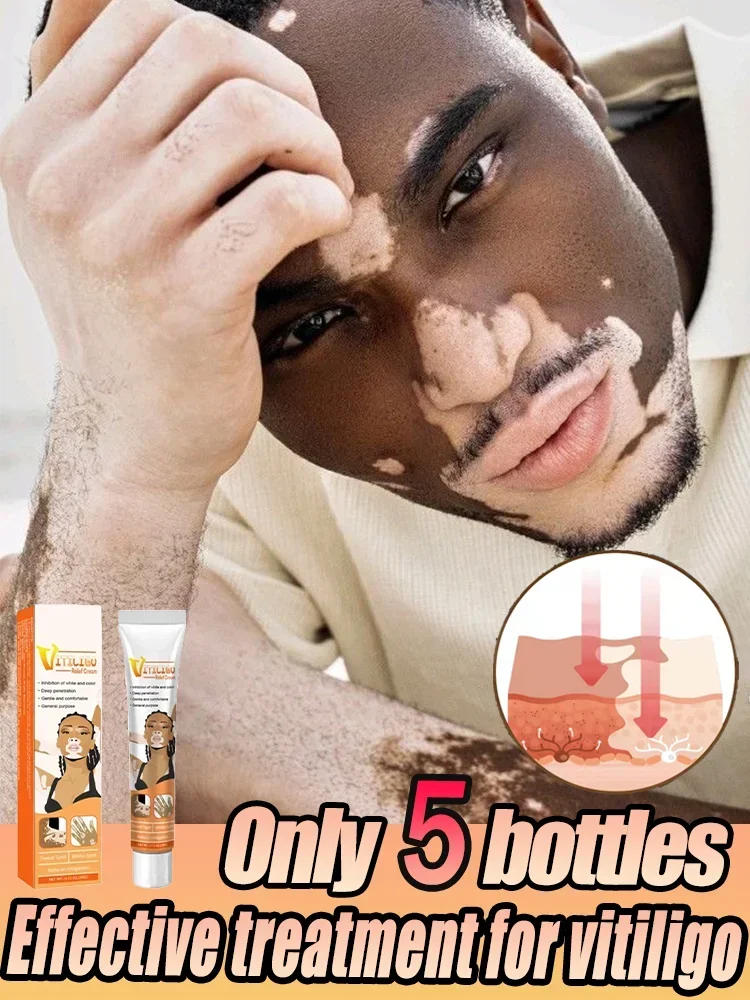 ⁿⁱᶜᵉ Vitiligo Organics for White Spots Skin Repair Pigmentation