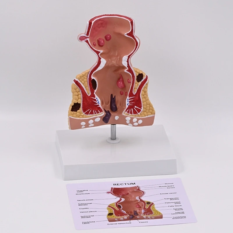 Модель человеческих патологий прямой кишки Модель прямой кишки человека Модель обучения медицине