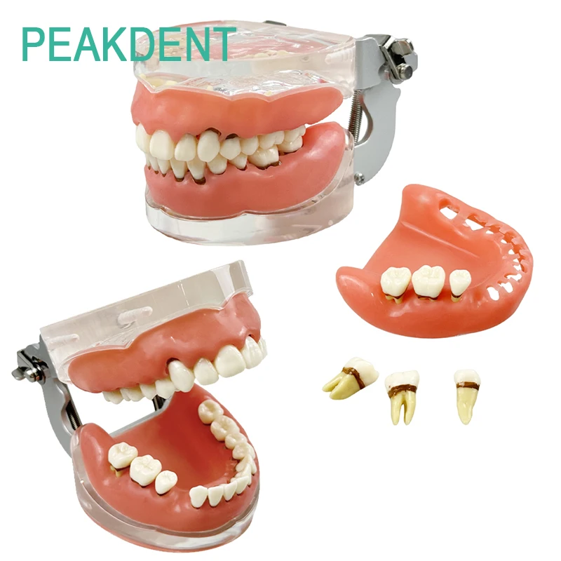 

1 шт., модель зубного камня, прозрачный корень, съемная модель десен, стоматология, обучение, исследование, демонстрация модели