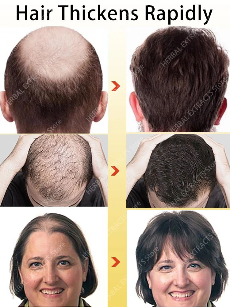 

Hot selling product, 99% of buyers buy again, have more and more hair, say goodbye to baldness, thick hair