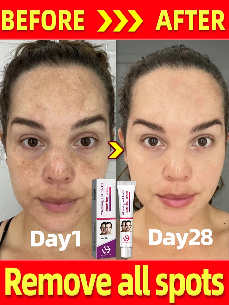 

dark spots remover cream for melasma on the face