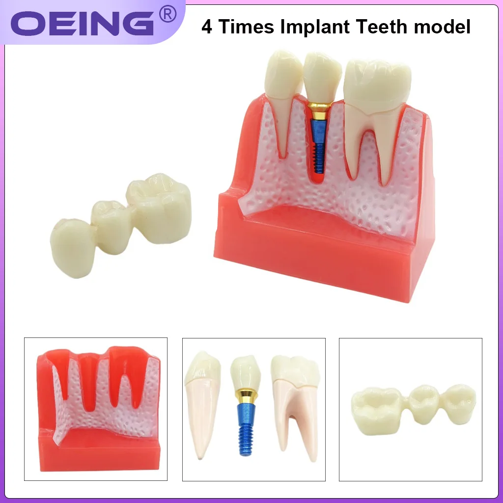 OEING 1Pc Dental 4 Times Teeth Model Implant Analysis Crown Bridge Demonstration Removable Model Lab Oral Research Tools