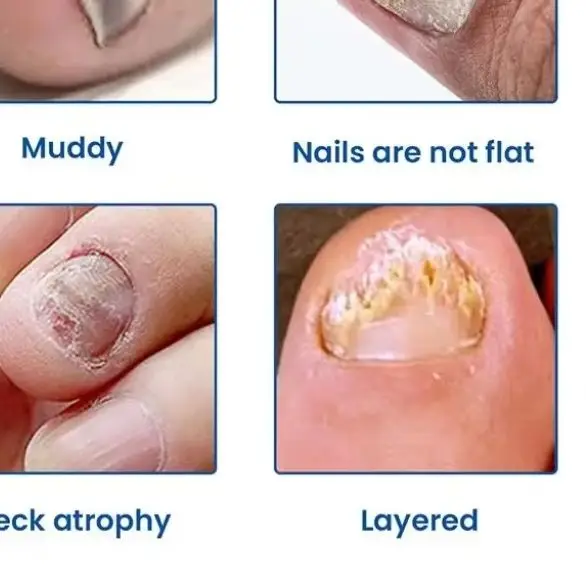 

Усовершенствованный лазерный аппарат для удаления грибка ногтей (905 нм инфракрасный и 470 нм синий лазер), эффективное лечение онихомикоза в домашних условиях